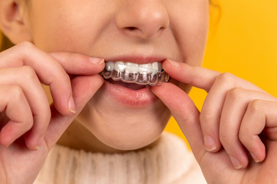 A patient fitting a clear dental aligner